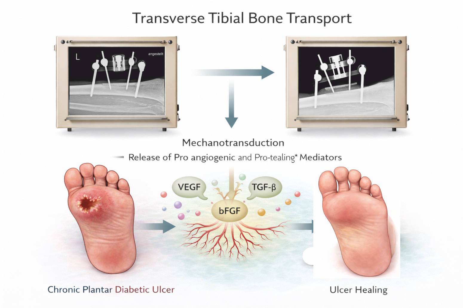 Tibia Ulcer Transverse Tibial Bone Transport: Another Brick in the Wall for the ...