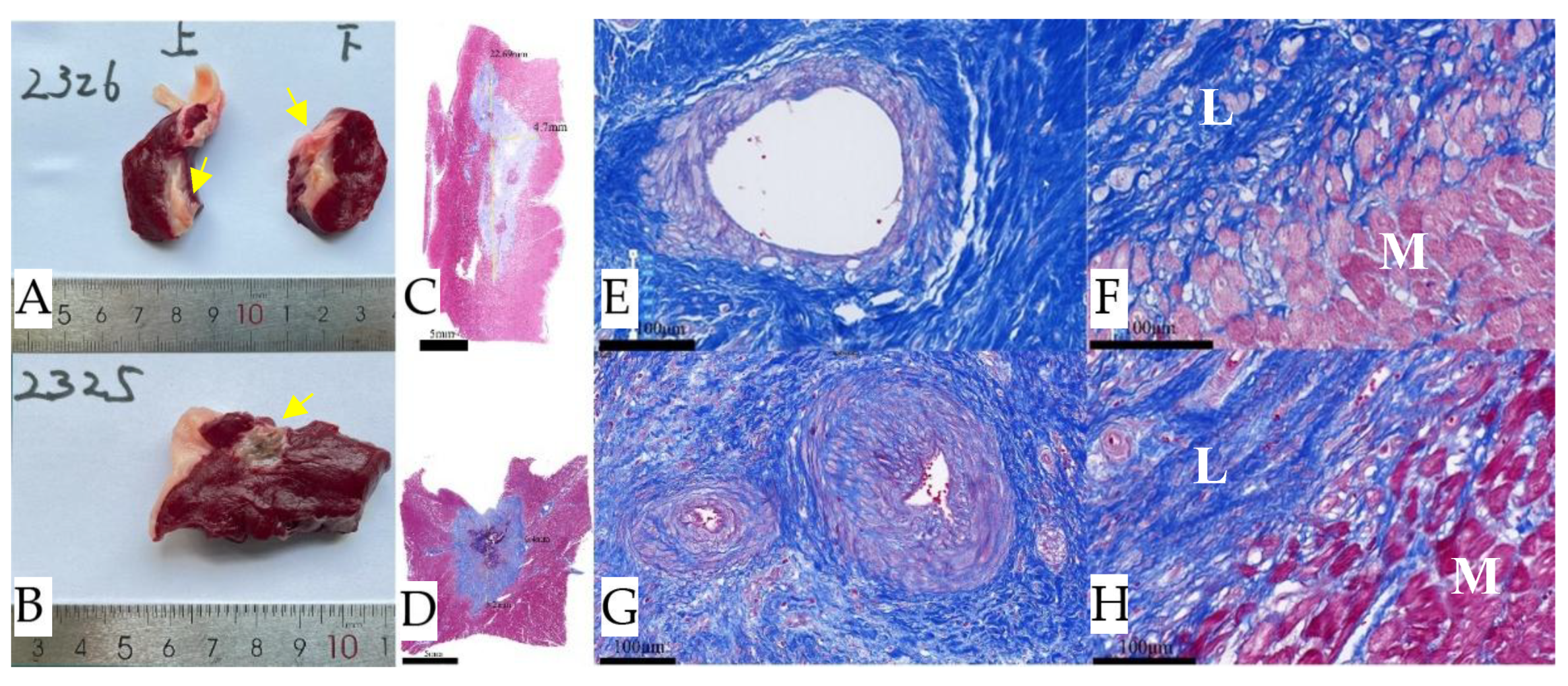 Percutaneous Intramyocardial Septal Ablation with Nanosecond