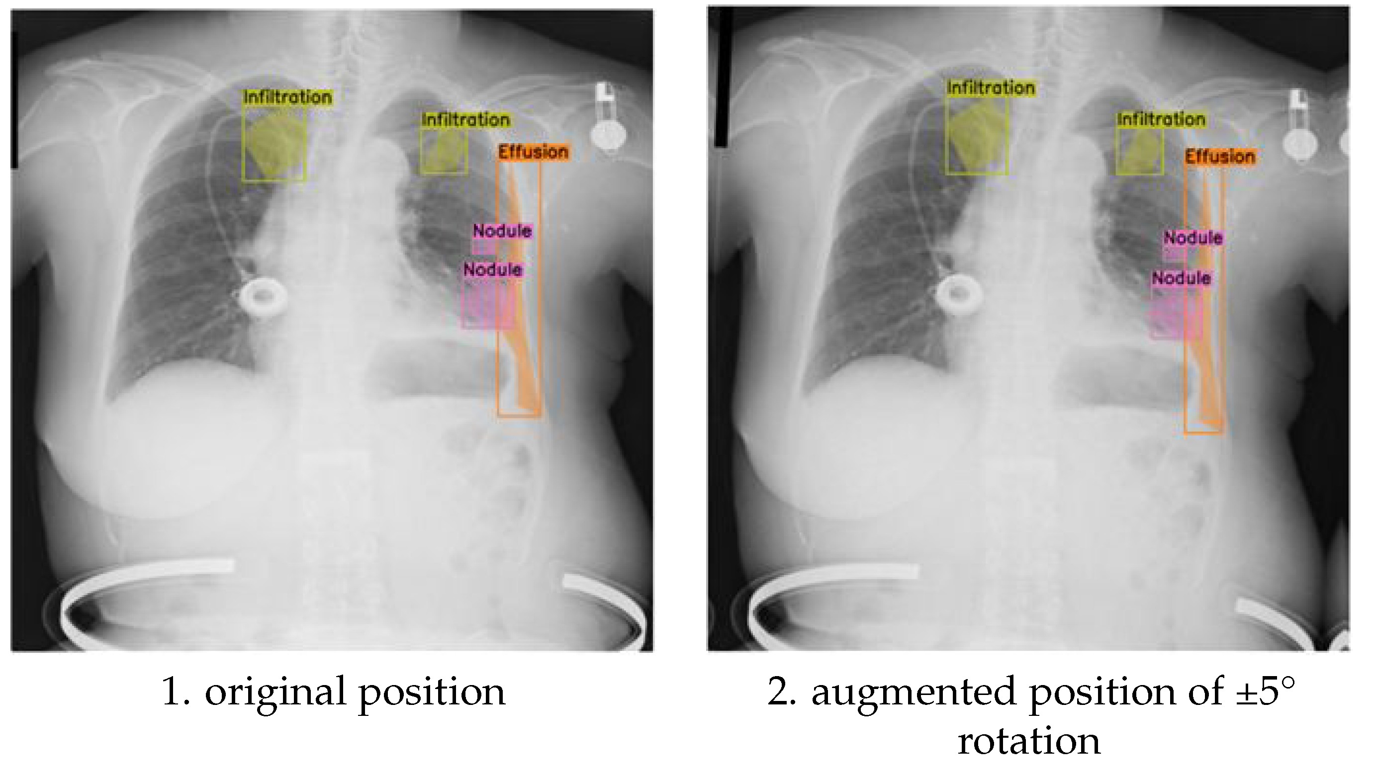 NCT-CXR: Enhancing Pulmonary Abnormalities Segmentation on