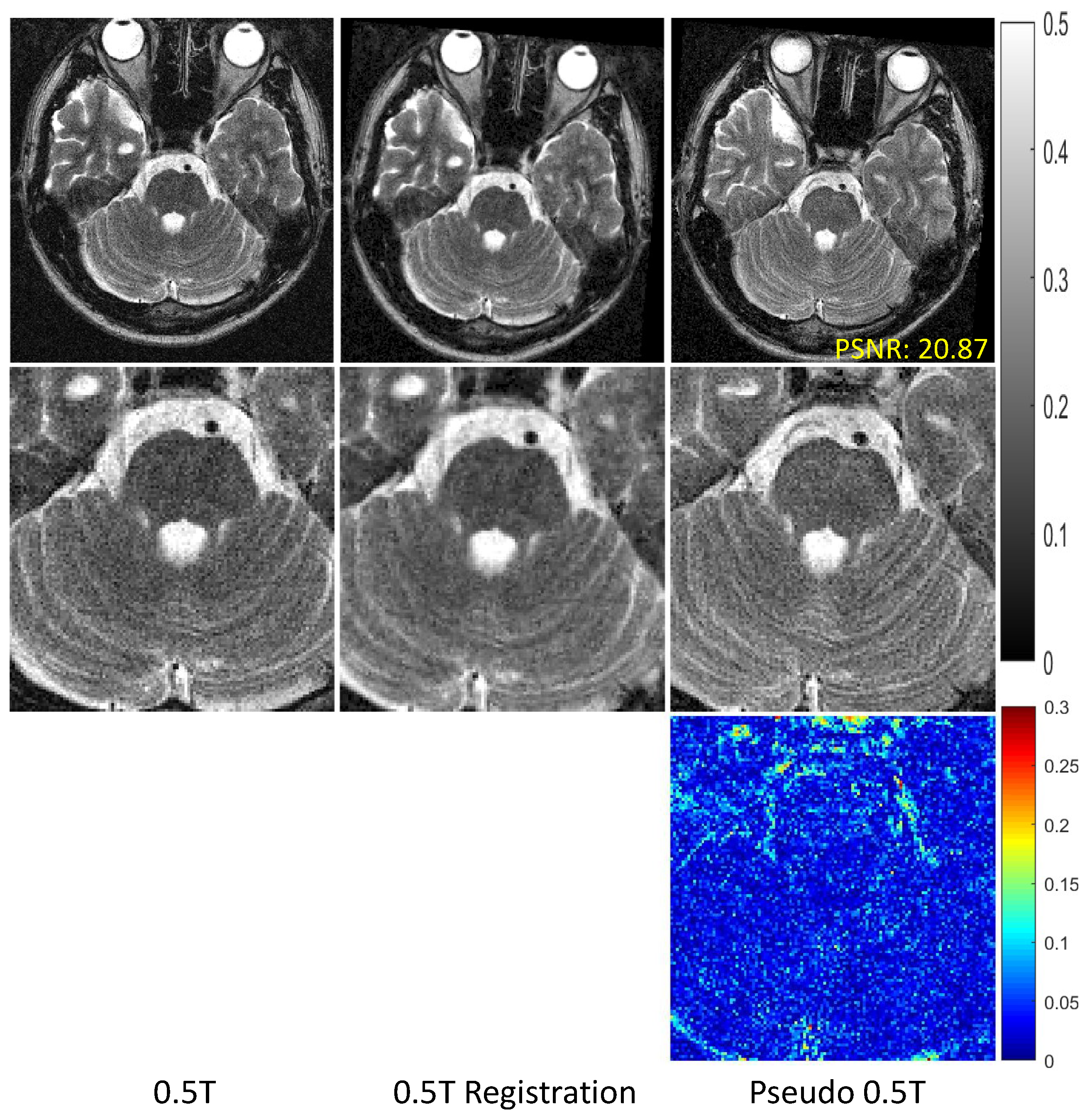 Meta-Learning–Driven Score-Based Generative Model for 0.5T-to-1.5T