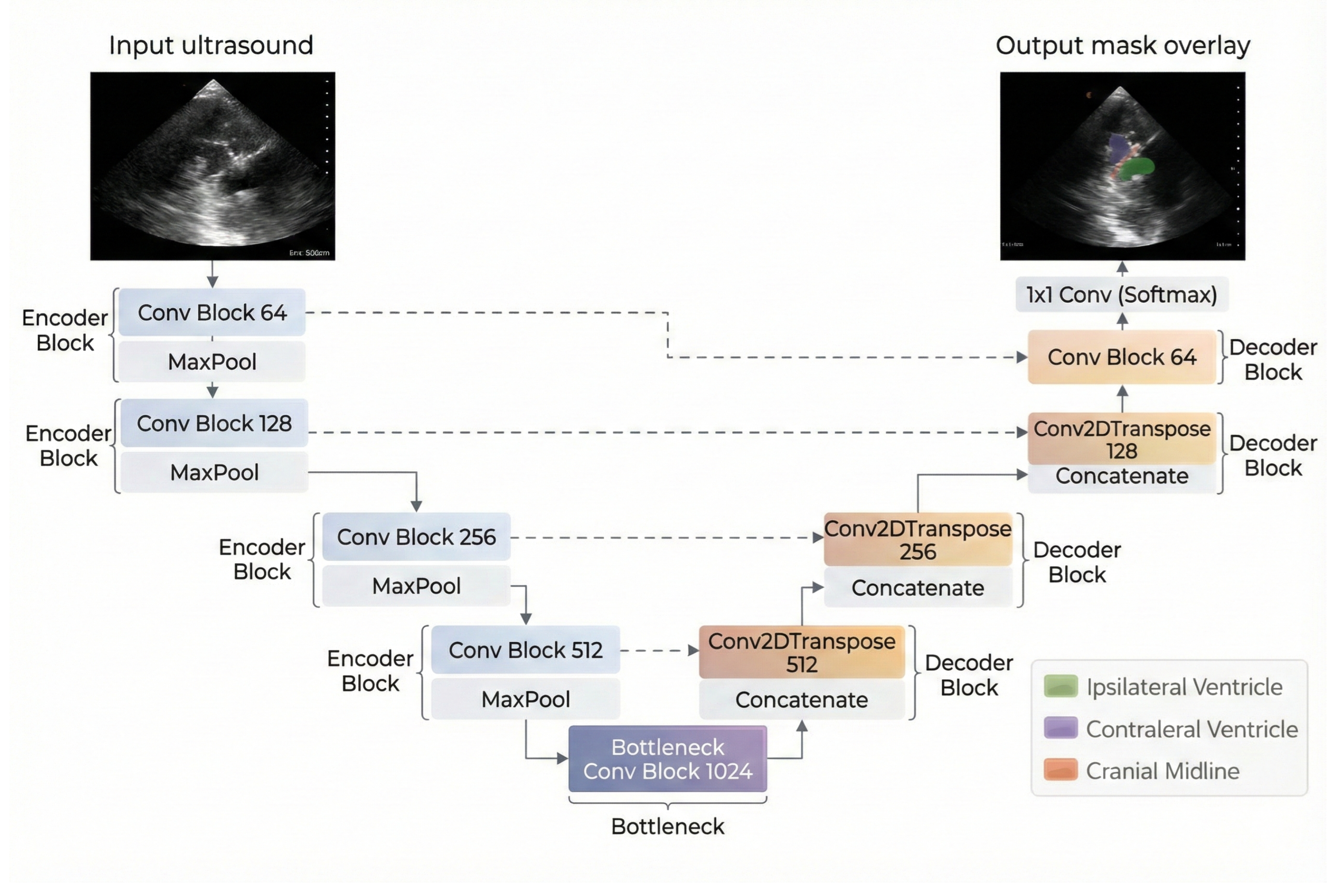 Automated Ventricular and Midline Segmentation in Cranial Ultrasound ...