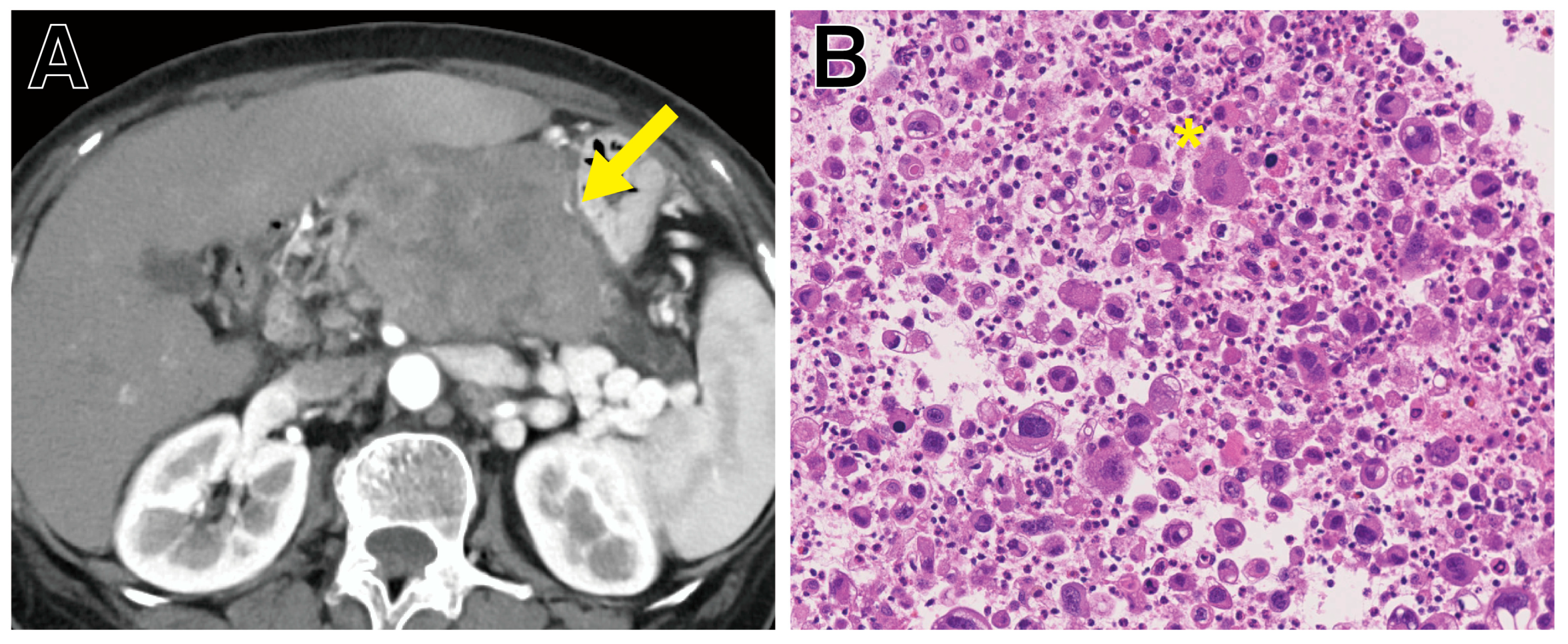 Understanding Polyploid Giant Cancer Cells: From Molecular
