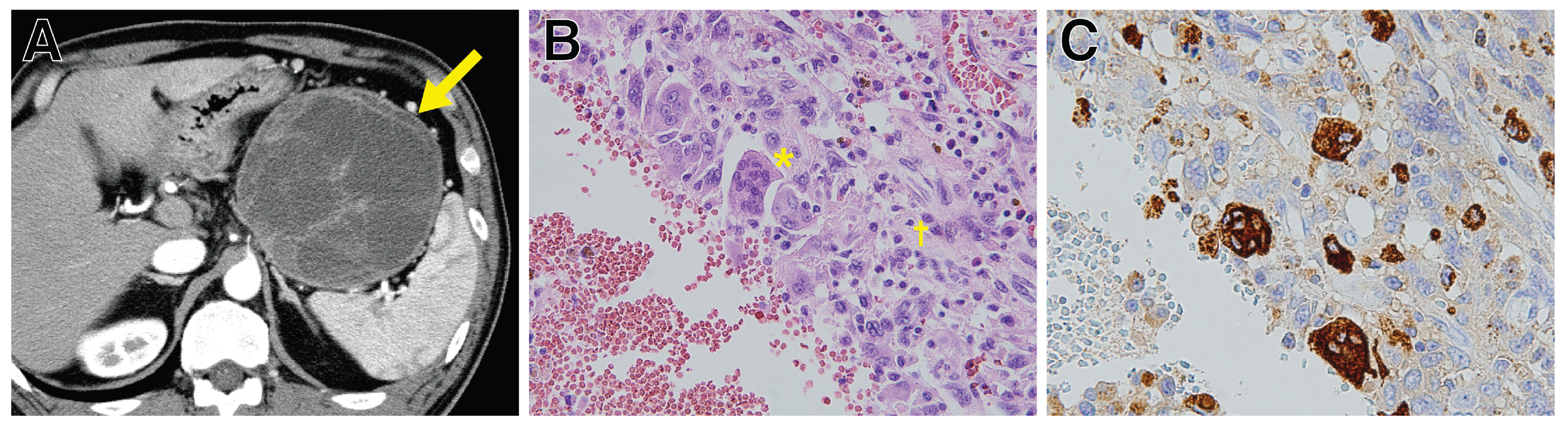 Understanding Polyploid Giant Cancer Cells: From Molecular