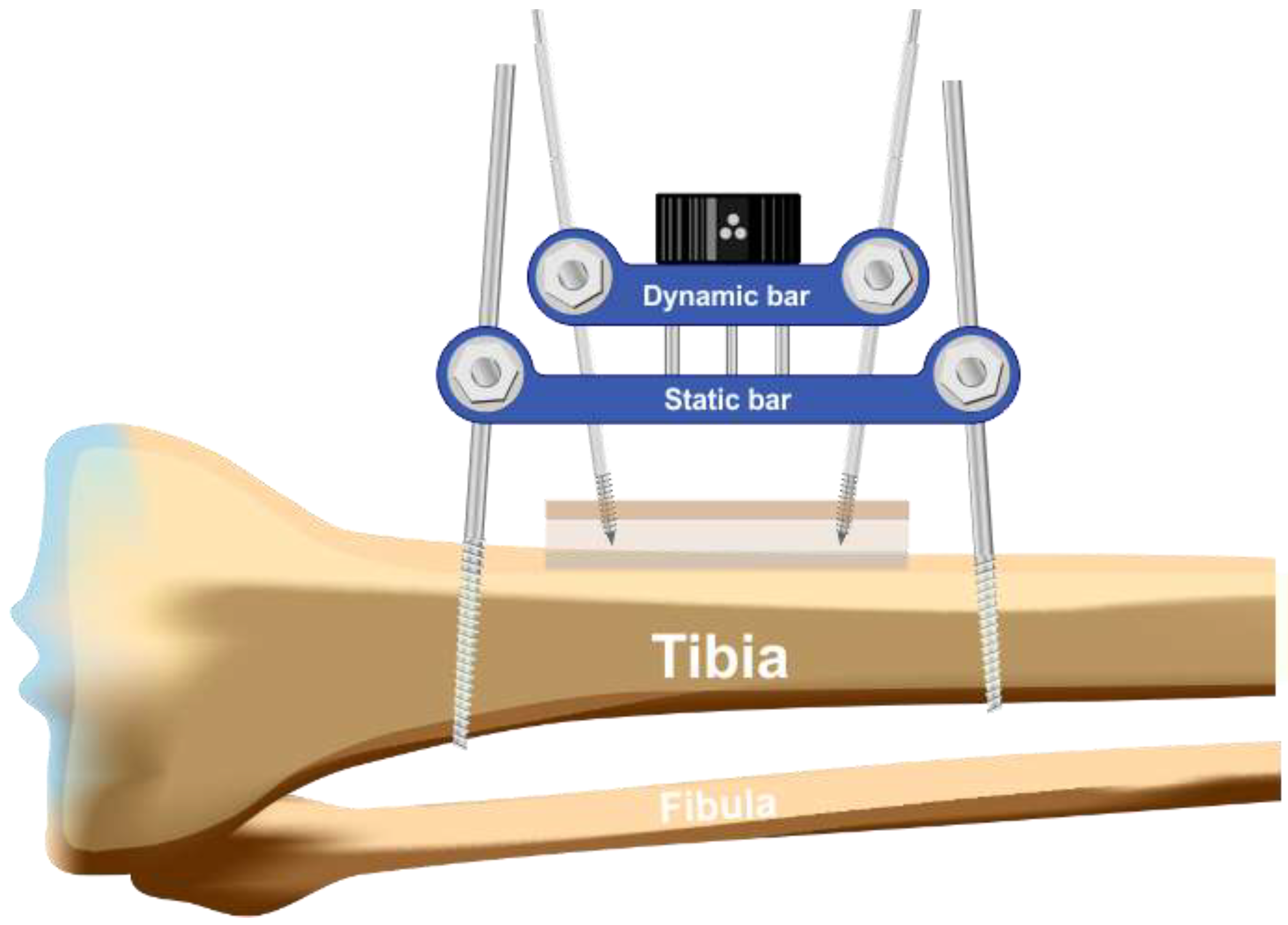 Tibia Ulcer Transverse Tibial Bone Transport: Another Brick in the Wall for the ...