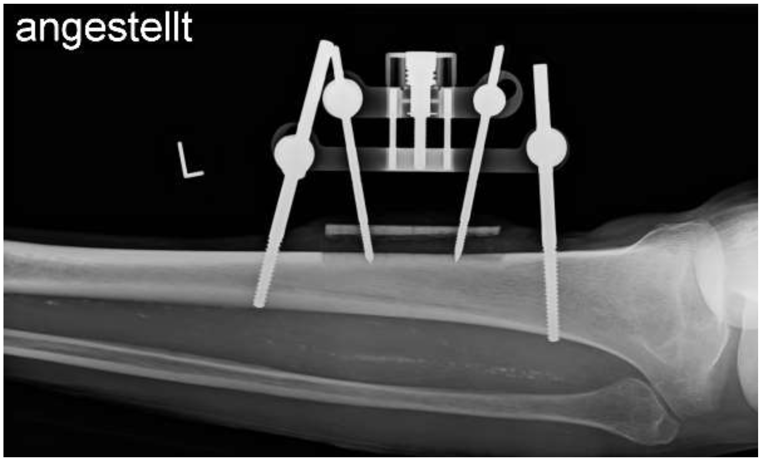 Tibia Ulcer Transverse Tibial Bone Transport: Another Brick in the Wall for the ...