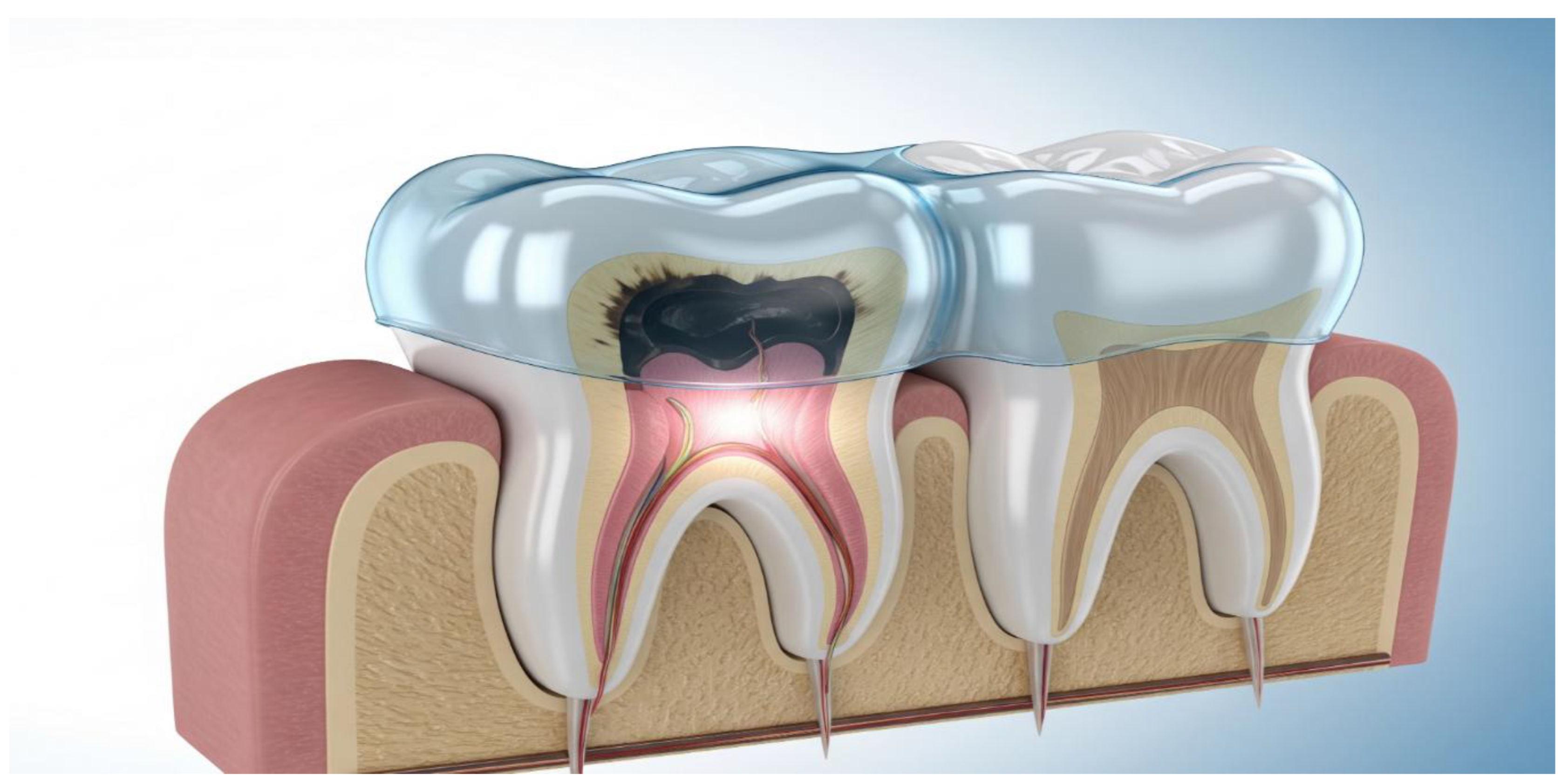 Management of Deep Caries in Primary Molars: A Comparative Analysis of ...
