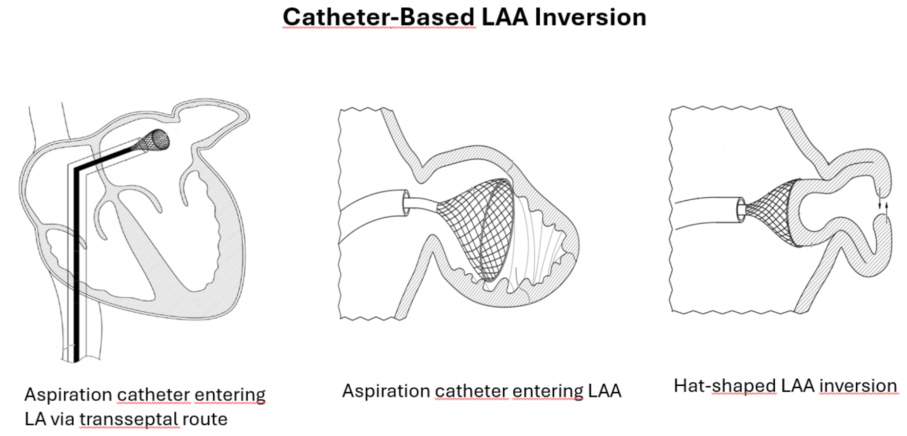 Vacuum-Assisted Catheter-Based Inversion of the Left Atrial Appendage ...