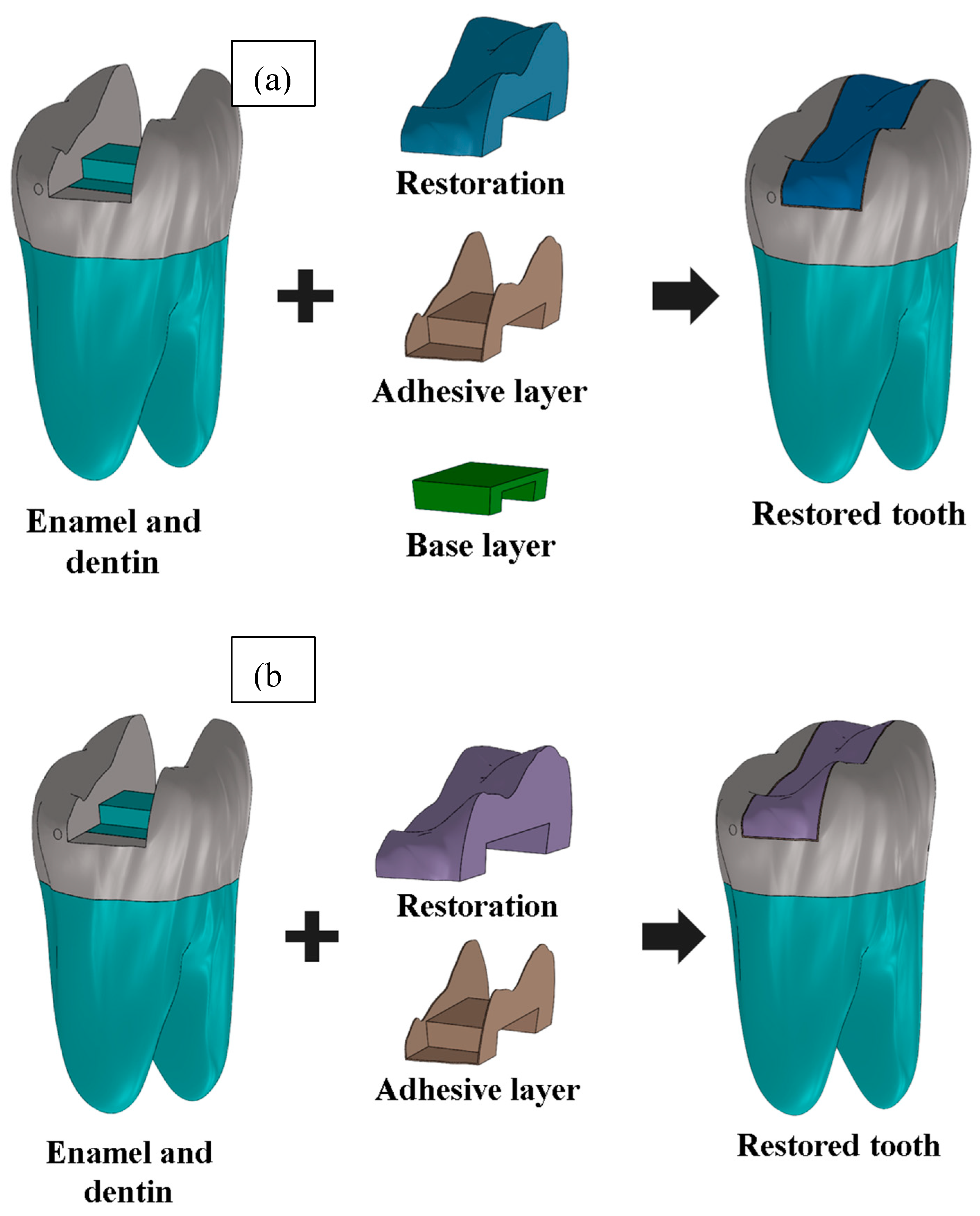 Mod Teeth Biomechanical Response of Class II MOD Restorations Con-Sidering ...