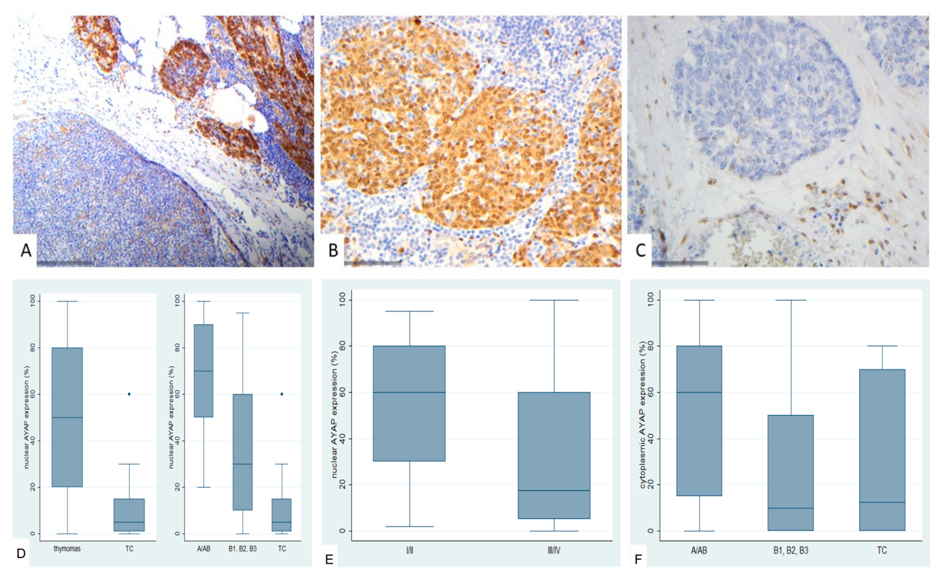レイ Hippo Pathway Dysregulation in Thymic Epithelial Tumors