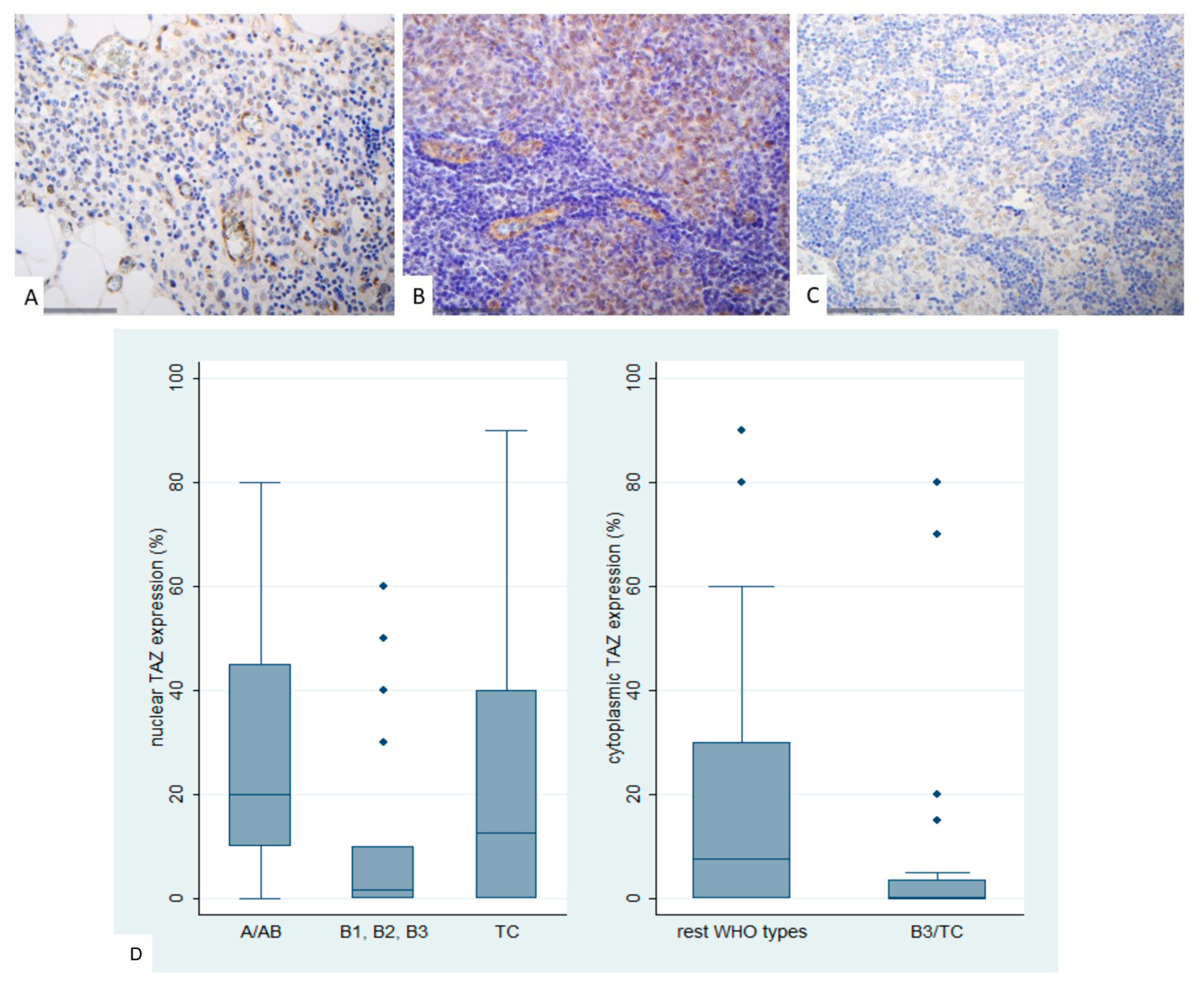 レイ Hippo Pathway Dysregulation in Thymic Epithelial Tumors