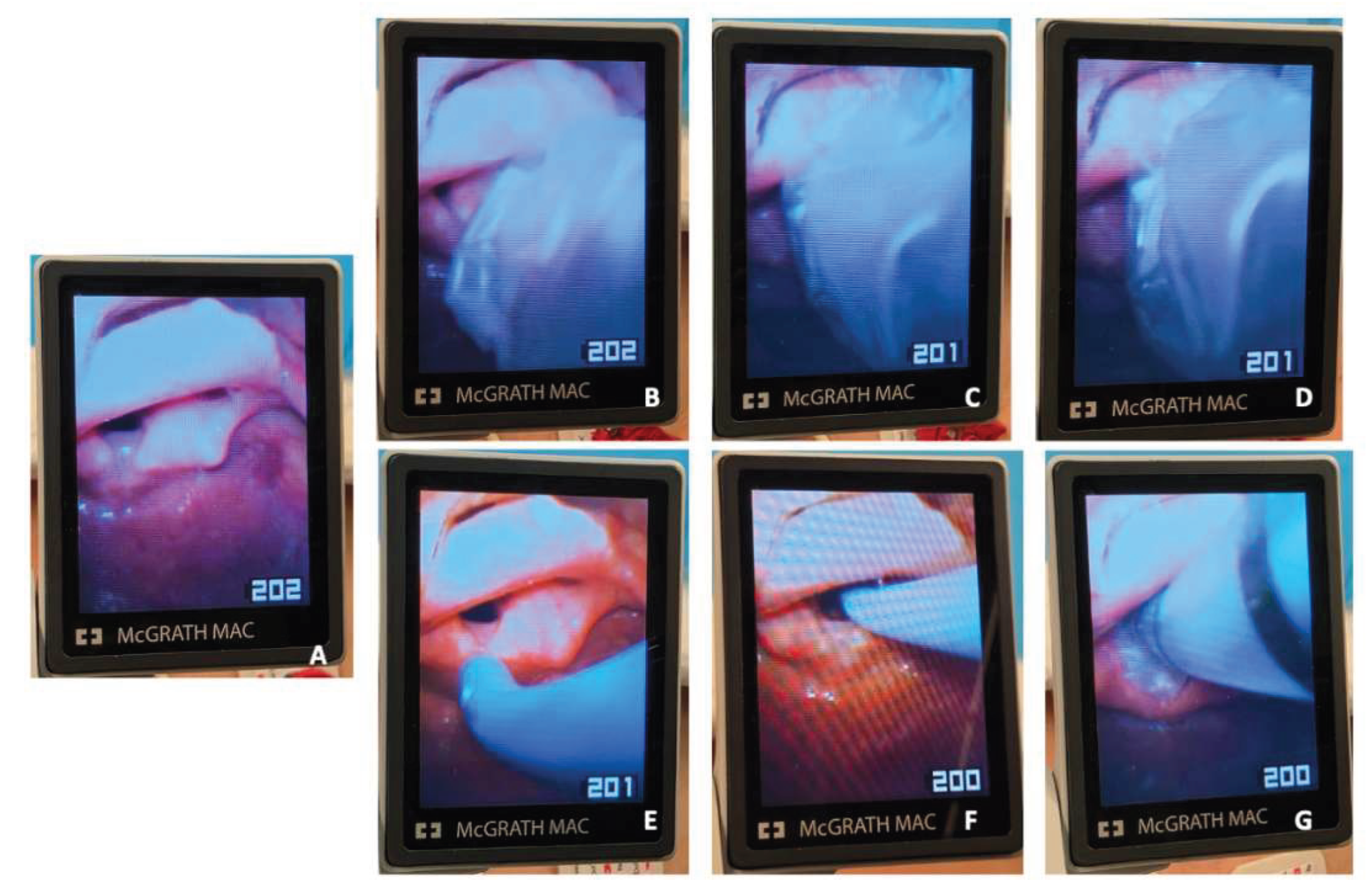 The Evolution of Laryngoscopy[v1] | Preprints.org