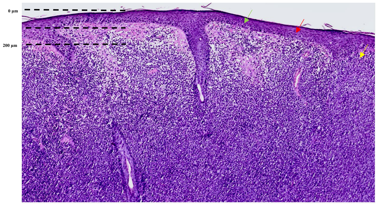 Dermoscopic and Reflectance Confocal Microscopic Features of a Primary  Cutaneous Anaplastic Large Cell Lymphoma (C-ALCL) of the Eyelid: A Case  Report with Histopathologic Correlation[v1] | Preprints.org