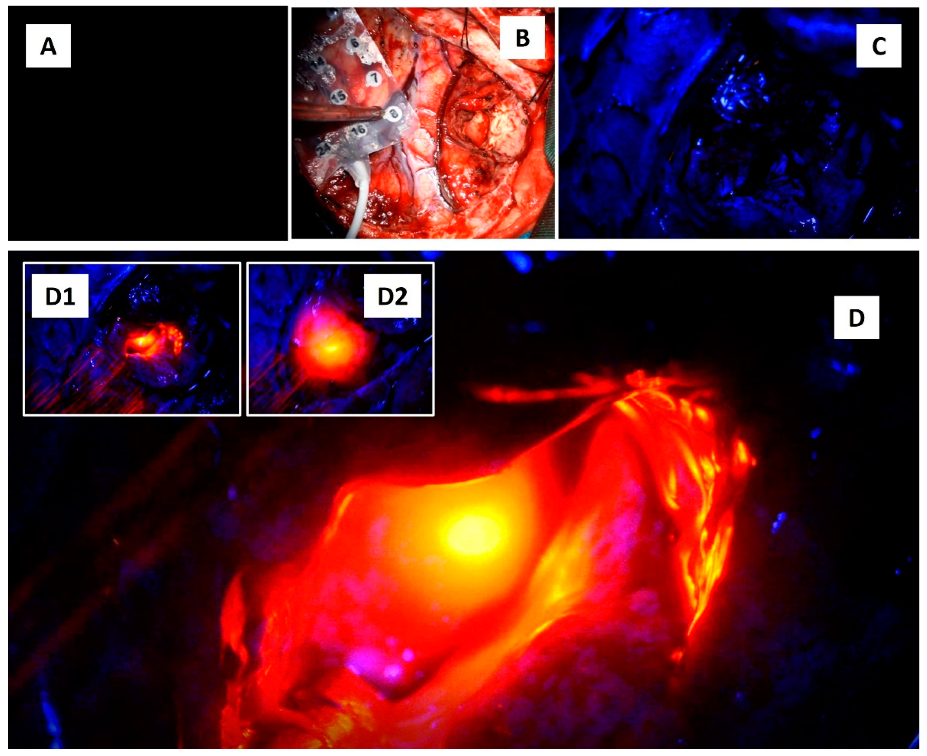 Light and Brain: A Clinical Case Depicting the Effects of Light on