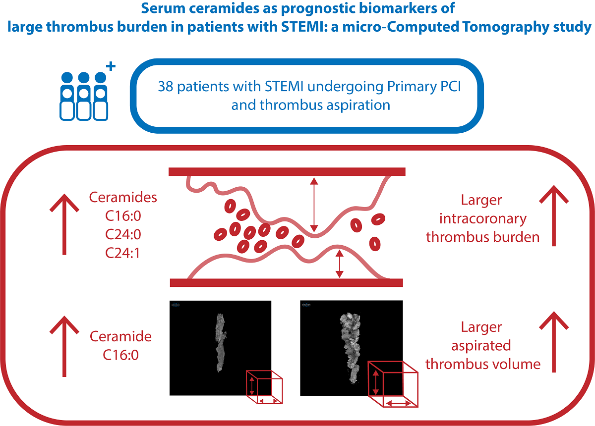 Serum Ceramides As Prognostic Biomarkers Of Large Thrombus Burden In Patients With Stemi A Micro Computed Tomography Study V1 Preprints