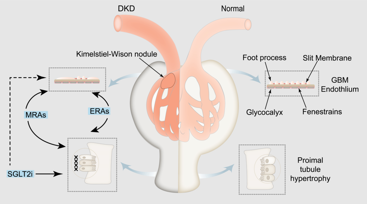 Understanding Proteinuria in Patients with Diabetic Kidney Disease and