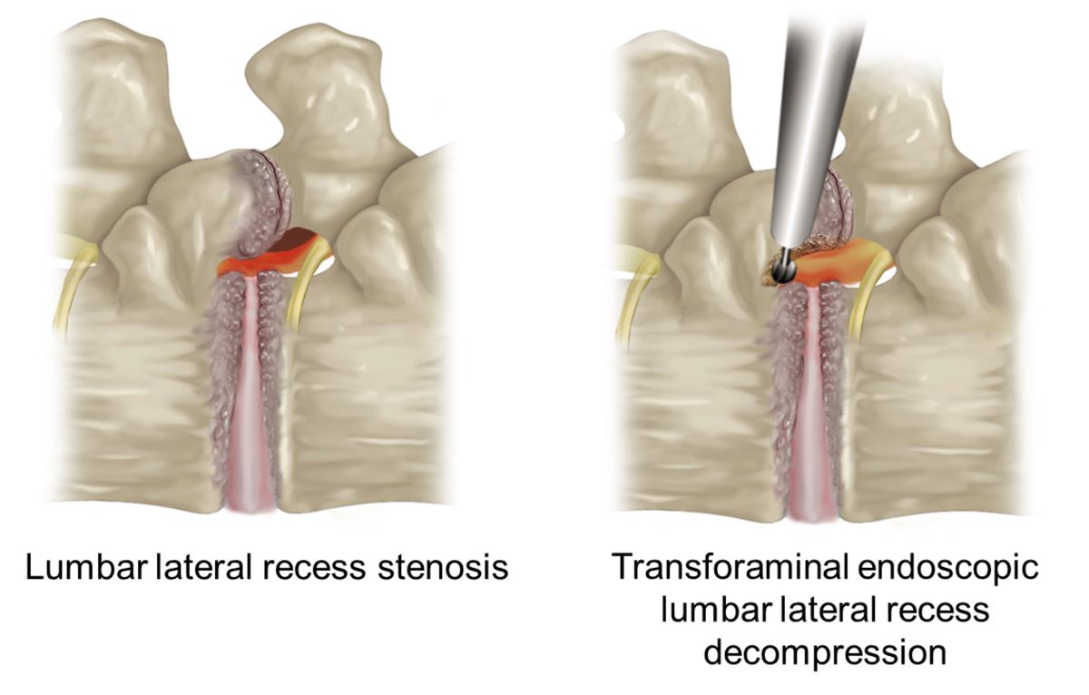 Transforaminal Endoscopic Lumbar Lateral Recess for