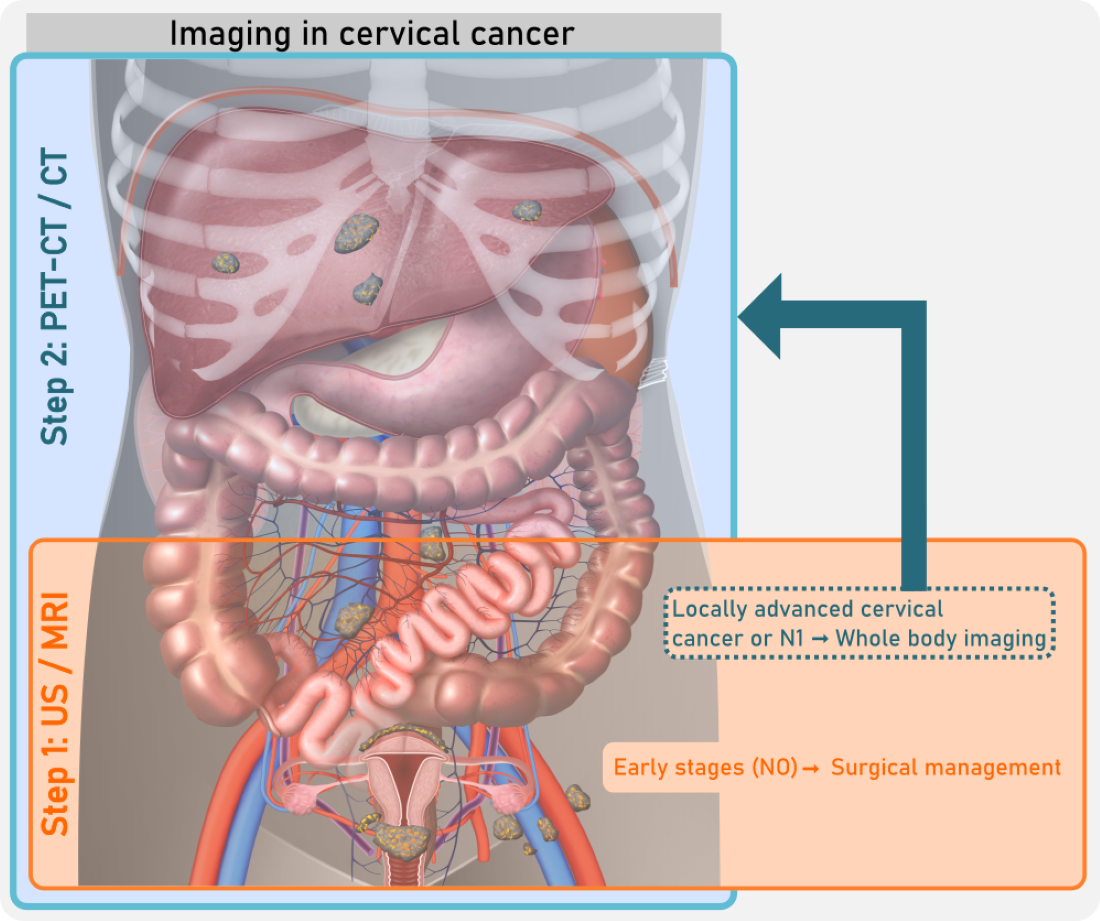 The Role of Imaging in Cervical Cancer Staging – ESGO/ESTRO/ESP Guidelines ( Update 2023)[v1]